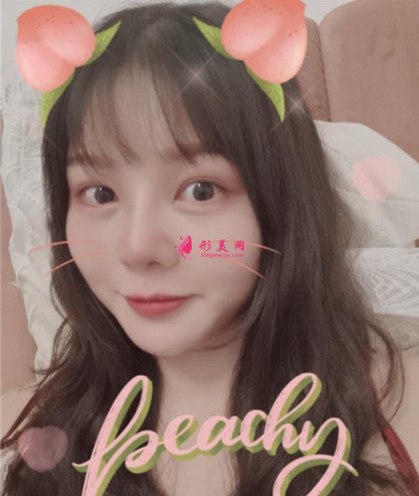 廣東省第二人民醫(yī)院整形美容科做隆鼻怎么樣？看專家案例價(jià)格查詢