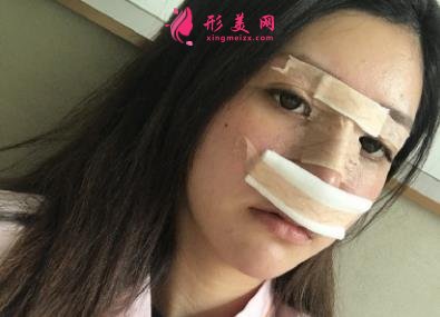 鄭大一附院整形科做鼻子怎么樣？醫(yī)生案例及價(jià)格價(jià)目表公開反饋