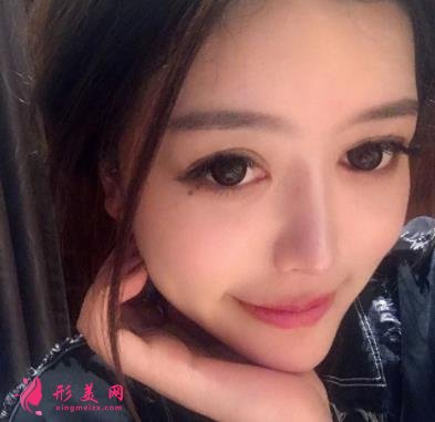 鄭大一附院整形科做鼻子怎么樣？醫(yī)生案例及價(jià)格價(jià)目表公開反饋