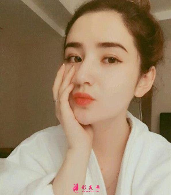 河南整形醫(yī)院鼻綜合恢復(fù)過程分享，不化妝無美顏不修圖的案例在此