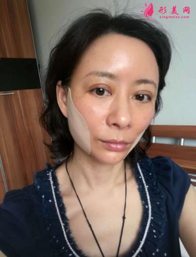 北京瑞麗馮立哲多維拉面部提升怎么樣？案例及效果圖公開查詢