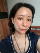 北京瑞麗馮立哲多維拉面部提升怎么樣？案例及效果圖公開查詢