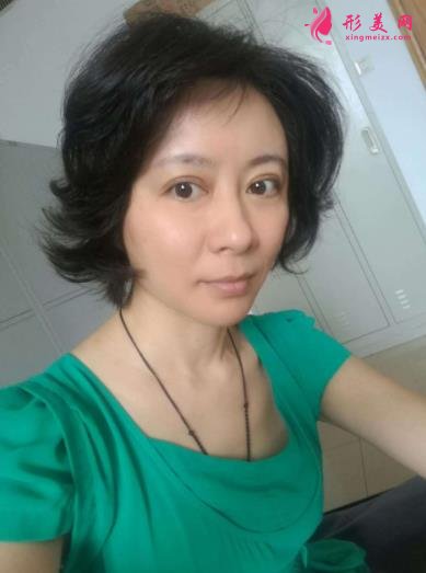 北京瑞麗馮立哲多維拉面部提升怎么樣？案例及效果圖公開查詢