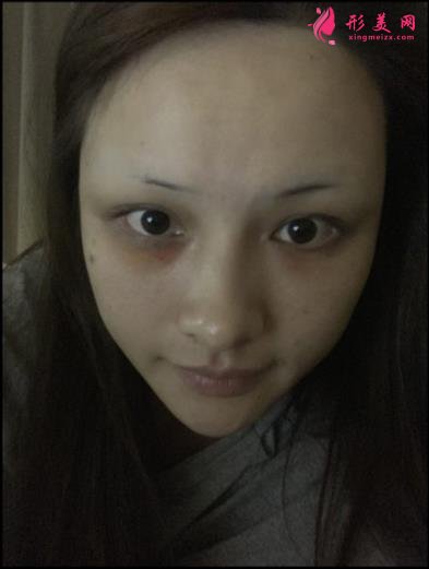 寧波壹加壹整形醫(yī)院怎么樣？從簡介及激光去眼袋案例、價(jià)格收費(fèi)可以看出
