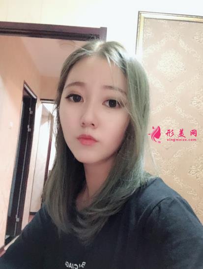 濮陽市人民醫(yī)院整形科價格價目表收費公開！隆鼻案例對比反饋~
