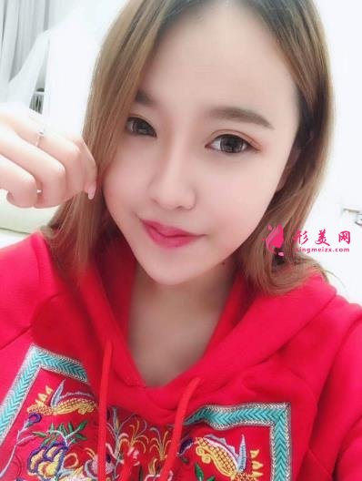 徐州醫(yī)院雙眼皮做得好嗎？案例效果分享_眼部修復(fù)干貨盤點(diǎn)