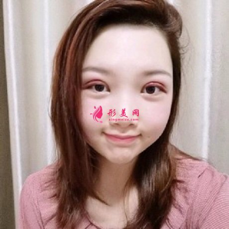天津公安醫(yī)院雙眼皮怎么樣？哪些人不能做雙眼皮手術(shù)？