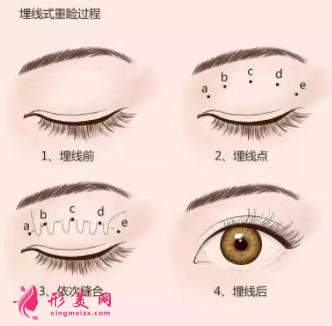 天津公安醫(yī)院雙眼皮怎么樣？哪些人不能做雙眼皮手術(shù)？