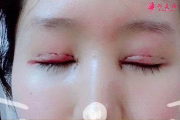 大連醫(yī)大二院雙眼皮怎么樣?切開雙眼皮手術前后效果對比
