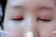 大連醫(yī)大二院雙眼皮怎么樣?切開雙眼皮手術(shù)前后效果對比
