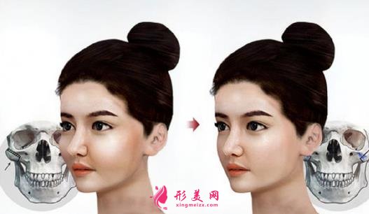 上海九院下頜角磨骨怎么樣？特色技術(shù)分析和案例效果圖匯總！你評評效果如何