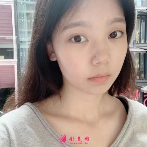 上海九院下頜角磨骨怎么樣？特色技術(shù)分析和案例效果圖匯總！你評評效果如何
