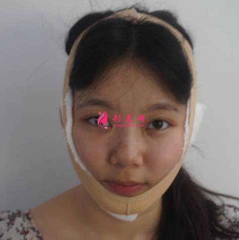 上海九院下頜角磨骨怎么樣？特色技術(shù)分析和案例效果圖匯總！你評評效果如何