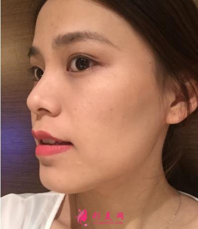 福州海峽美容醫(yī)院去眼袋怎么樣？技術(shù)特色、案例、價(jià)格收費(fèi)雙雙公開(kāi)