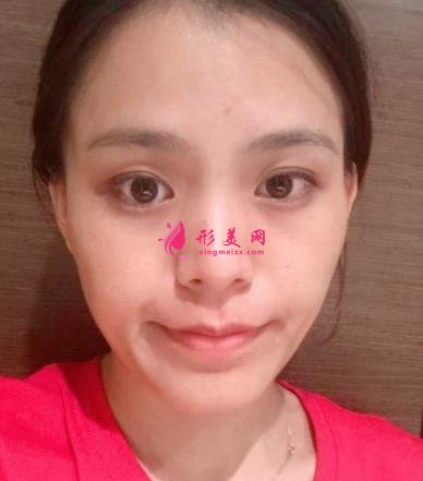 福州海峽美容醫(yī)院去眼袋怎么樣？技術(shù)特色、案例、價(jià)格收費(fèi)雙雙公開(kāi)