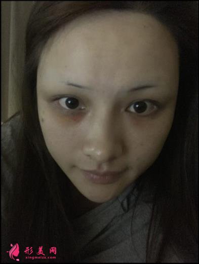 寧波壹加壹整形醫(yī)院怎么樣？從簡介及激光去眼袋案例、價格收費可以看出