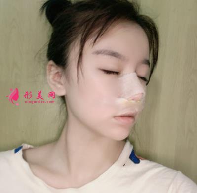 蘇州昆山百達(dá)麗醫(yī)療美容靠譜嗎？做鼻子真實(shí)案例及價(jià)目表_口碑介紹