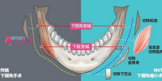上海九院下頜角磨骨怎么樣？特色技術(shù)分析和案例效果圖匯總！你評評效果如何