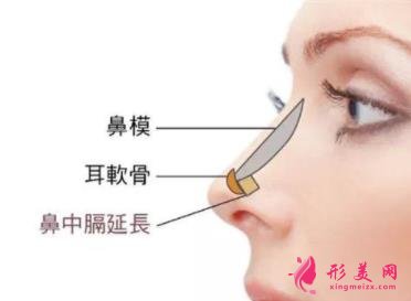 浙一醫(yī)院鼻綜合手術(shù)案例分享!鼻翼縮小術(shù)價格是多少錢?
