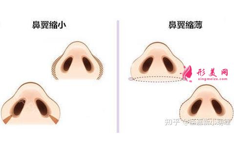 湘雅醫(yī)院鼻綜合手術(shù)案例分享!鼻孔縮小術(shù)你了解多少？