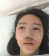 西京醫(yī)院鼻綜合怎么樣？鼻孔不對稱怎么辦？手術(shù)矯正詳解