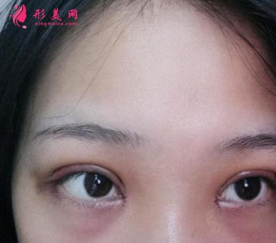 廣州曙光醫(yī)院做雙眼皮手術(shù)怎么樣？多少錢？眼整形案例及費用價格查詢