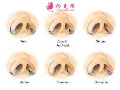 天津醫(yī)院鼻綜合怎么樣？鼻翼縮小手術(shù)適合人群及價(jià)格分享