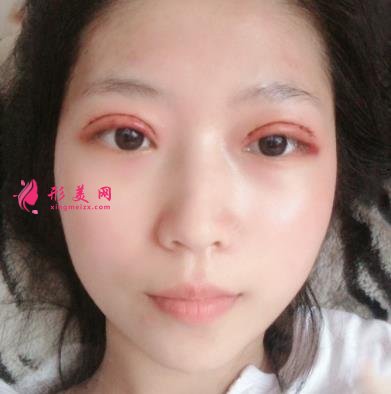 武漢金國(guó)華雙眼皮怎么樣？個(gè)人資料技術(shù)科普_再看專家案例和收費(fèi)區(qū)間表