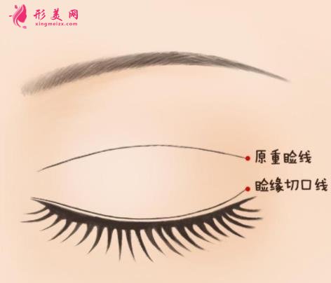武漢金國(guó)華雙眼皮怎么樣？個(gè)人資料技術(shù)科普_再看專家案例和收費(fèi)區(qū)間表