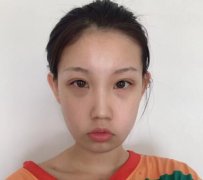 成都八大處整形醫(yī)院隆鼻案例曝光！還有價格收費(fèi)明細(xì)參考