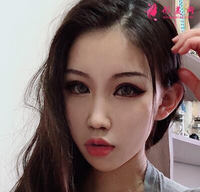 成都八大處整形醫(yī)院隆鼻案例曝光！還有價(jià)格收費(fèi)明細(xì)參考