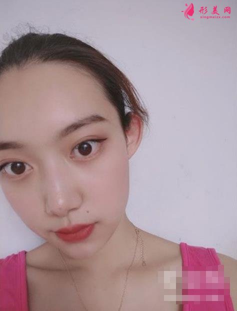 北京純脂孫澤芳面部填充脂肪案例反饋!整形價(jià)格全面一覽