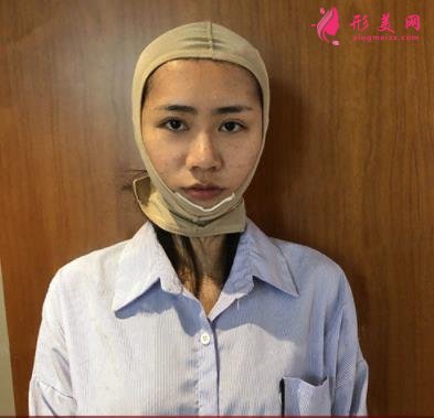 浙江普陀醫(yī)院整形外科面部吸脂怎么樣？真人案例及2021價格表公開