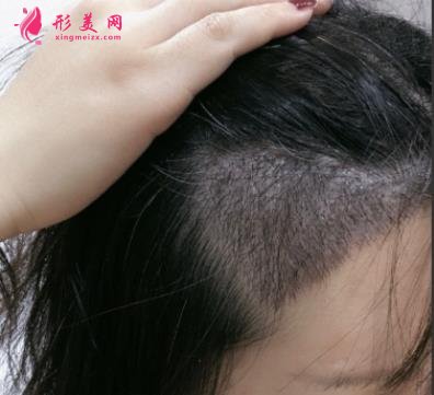 寧波市第六醫(yī)院整復(fù)外科種植發(fā)際線怎么樣？請看案例前后圖片及價格收費