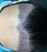 寧波市第六醫(yī)院種植發(fā)際線怎么樣？請看案例前后圖片及價格收費