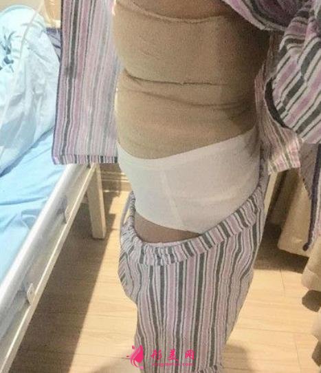 華西醫(yī)院整形科吸脂案例術(shù)后反饋！價格收費標準全新出爐~