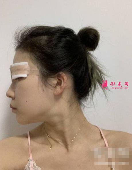 山大二院何茂文醫(yī)生做的雙眼皮咋樣?案例效果價(jià)格收費(fèi)表公開