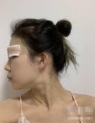 山大二院何茂文醫(yī)生做的雙眼皮咋樣?案例效果價(jià)格收費(fèi)表公開(kāi)