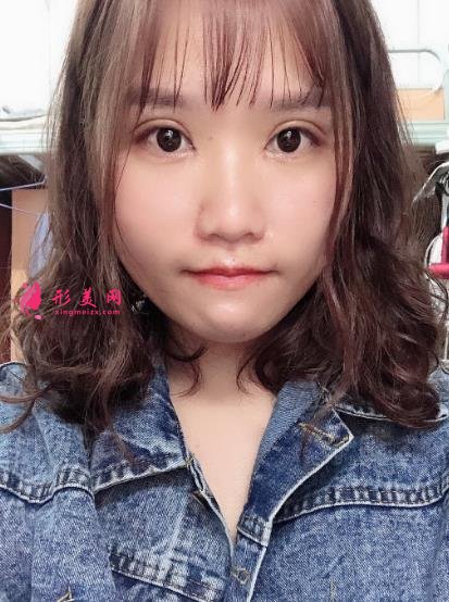 中日友好醫(yī)院整形科雙眼皮怎么樣？開眼角留疤了怎么辦？