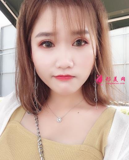 中日友好醫(yī)院整形科雙眼皮怎么樣？開眼角留疤了怎么辦？