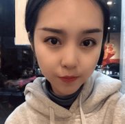 西安西京醫(yī)院雙眼皮怎么樣？為什么開內(nèi)眼角手術(shù)后眼角縮回？