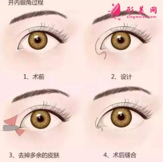 西安西京醫(yī)院雙眼皮怎么樣？為什么開內(nèi)眼角手術(shù)后眼角縮回？