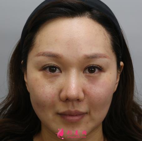 上海九院整形科熱瑪吉抗衰效果怎么樣？看案例即可見(jiàn)證！附價(jià)格表