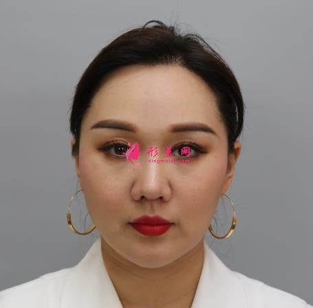 上海九院整形科熱瑪吉抗衰效果怎么樣？看案例即可見(jiàn)證！附價(jià)格表