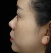 浙醫(yī)二院整形科做熱瑪吉怎么樣？專家案例、價格表清單一一盡顯！