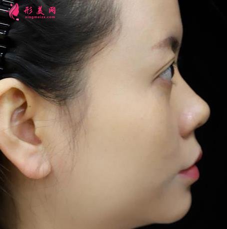浙醫(yī)二院整形科做熱瑪吉怎么樣？專家案例、價格表清單一一盡顯！