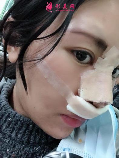 成都新麗美整形醫(yī)院隆鼻怎么樣？口碑案例和正規(guī)費(fèi)用（價(jià)格表）一覽
