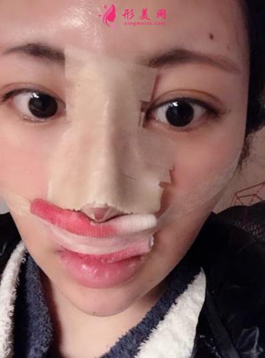 成都新麗美整形醫(yī)院隆鼻怎么樣？口碑案例和正規(guī)費(fèi)用（價(jià)格表）一覽