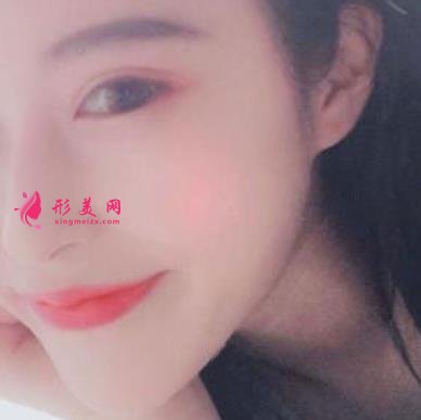 杭州整形醫(yī)院(杭州手外科醫(yī)院）做隆鼻怎么樣？專家案例及價(jià)格價(jià)錢表反饋