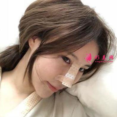 杭州整形醫(yī)院(杭州手外科醫(yī)院）做隆鼻怎么樣？專家案例及價(jià)格價(jià)錢表反饋
